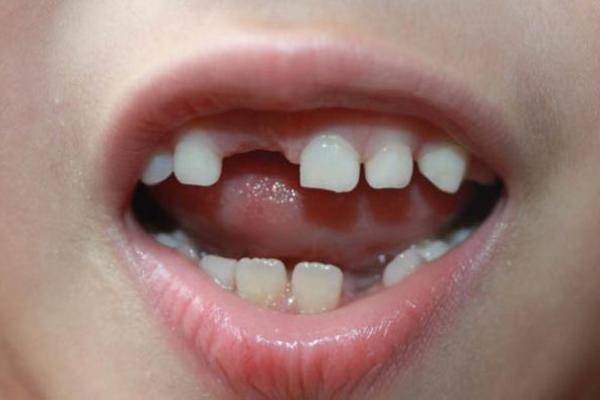 梦到掉牙齿是什么预兆男人